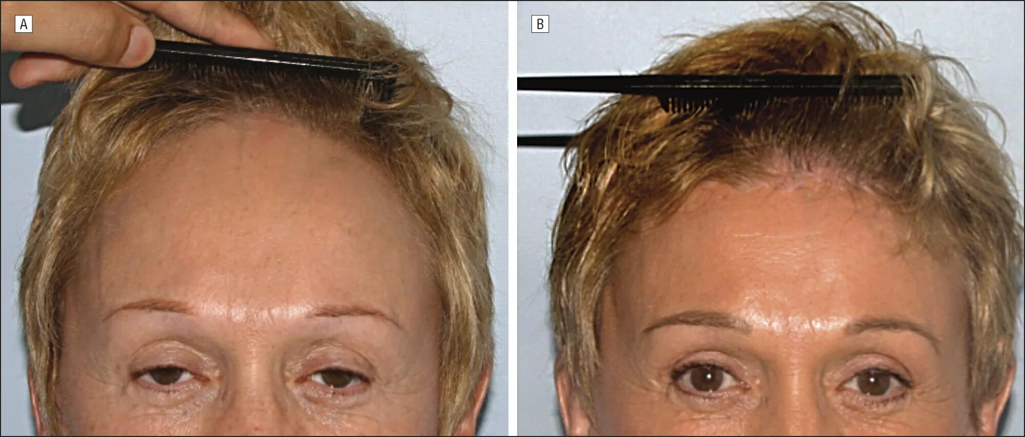 Лоб раньше. Опускание линии роста волос. Коррекция линии роста волос на лбу.