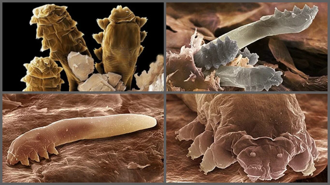 Кожное заболевание клещ демодекс. Железница угревая Demodex folliculorum.