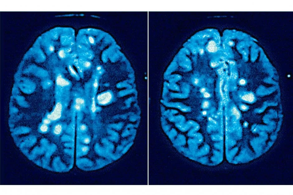 Склероз мозга. Рассеянный склероз на мрт головного мозга. Мрт головного мозга снимки рассеянный склероз. Рассеянный склероз головного мозга мрт т2 ви. Очаги рассеянного склероза на мрт.
