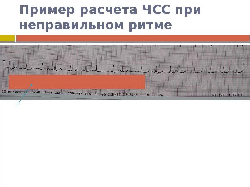 Пример чсс. Измерение чсс по экг.