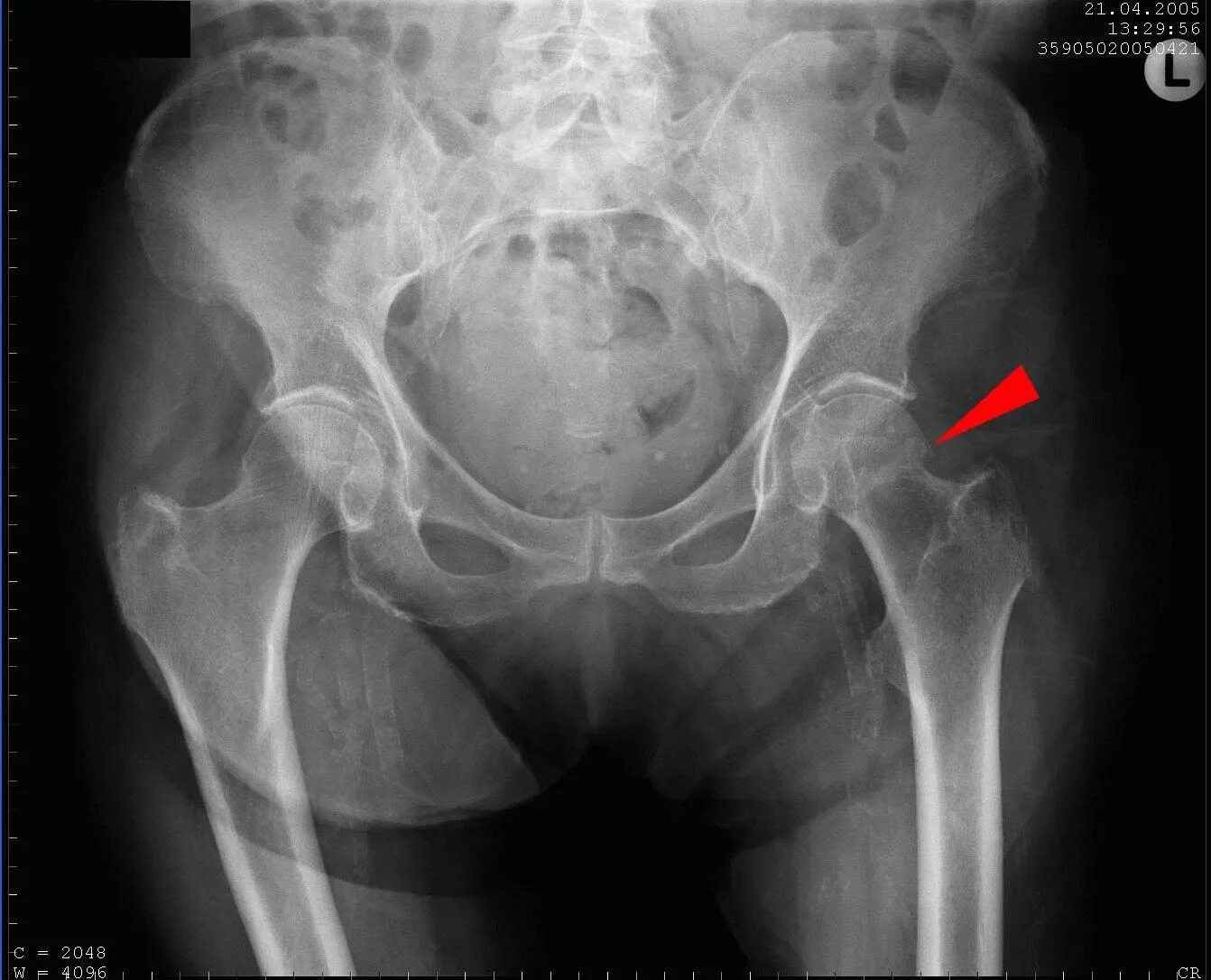 Перелом шейки бедра тазобедренного сустава. Перелом шейки бедра в пожилом возрасте на снимке. Рентгенограмма – перелом шейки бедрара. Субкапитальный перелом шейки бедра рентген. Перелом шейки бедренной кости рентген.