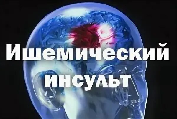 Инсульт правая сторона шанс