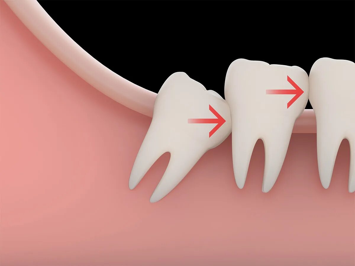 Зуб мудрости (3-й моляр, восьмерка). Two tooths