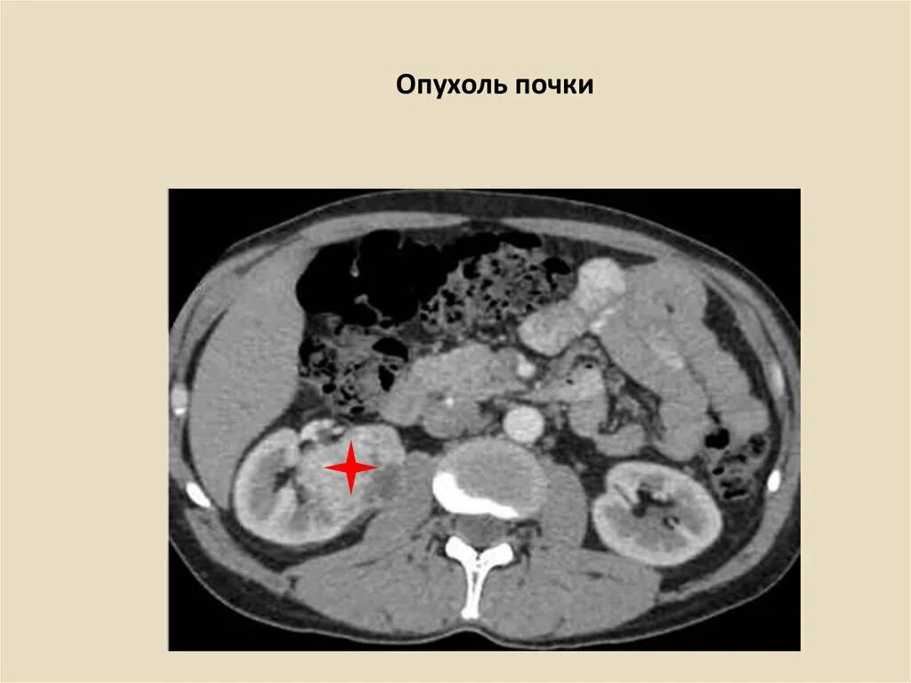 Нефробластома почки кт. Светлоклеточная карцинома почки кт. Рак почки причины