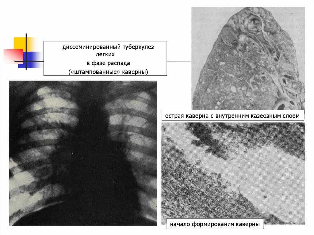 Диссеминированный туберкулез фаза инфильтрации