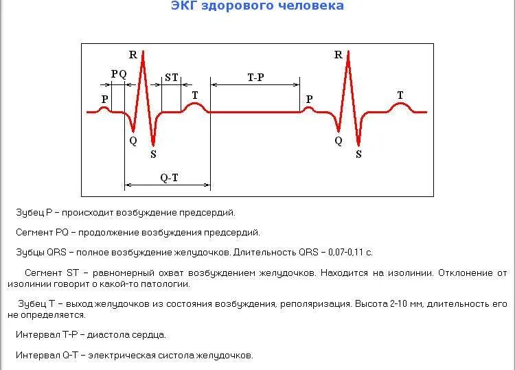Кардиограмма норма. Экг здорового сердца расшифровка. экг сердца с расшифровкой здорового человека. экг во втором стандартном отведении. кардиограмма экг сердца расшифровка.