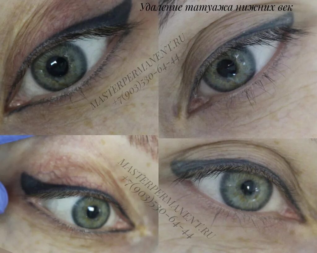 Удалить перманентный макияж век лазером. Удалить глаз татуаж. Как убрать татуаж с глаз. Татуаж век после лазера. Татуаж век сразу после процедуры.