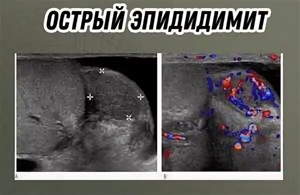 Орхит при паротите