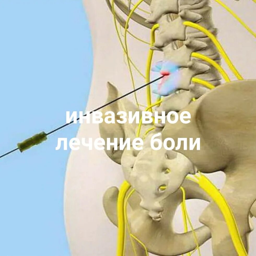 Блокада спины цена. Блокада пояснично-крестцового отдела позвоночника. Стимуляция крестцового нерва. Как делают блокаду позвоночника.