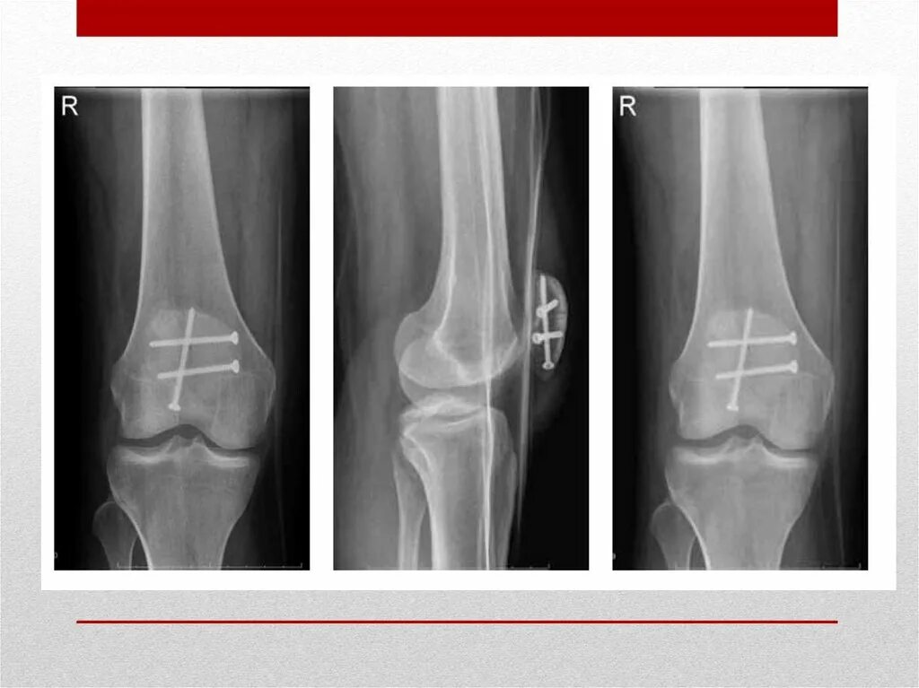 Трещина в коленной. Перелом надколенника рентген. Перелом коленного сустава рентген. Перелом чашечки коленного сустава рентген. Оскольчатый перелом надколенника.