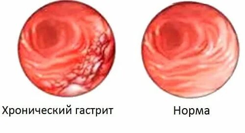 Гастрит клин. Хронический эрозивный гастрит. Диффузный катаральный гастрит. Вариолиформный гастрит.