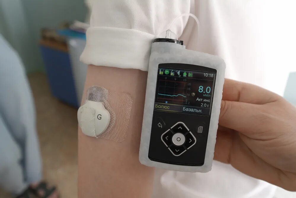 Инсулиновая помпа для диабетиков 1 типа. Инсулиновая помпа сахарном диабете у детей. Инсулиновая помпа для диабетиков. Инфузионный набор для инсулиновой помпы медтроник. Инсулиновая помпа омнипод.