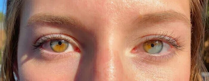 Как выглядит гетерохромия глаз Pin on EYES in 2024 Aesthetic eyes, Pretty eyes, Beautiful eyes
