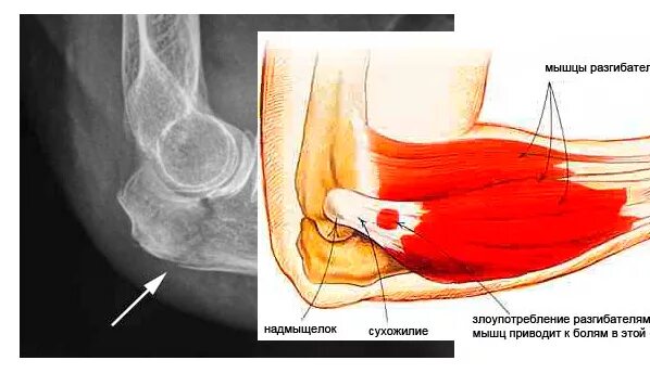 Болит локоть отдает в руку. Сухожилия локтевого сустава анатомия. Эпикондилит локтевого сустава лангетка. Мышцы локтевого сустава.