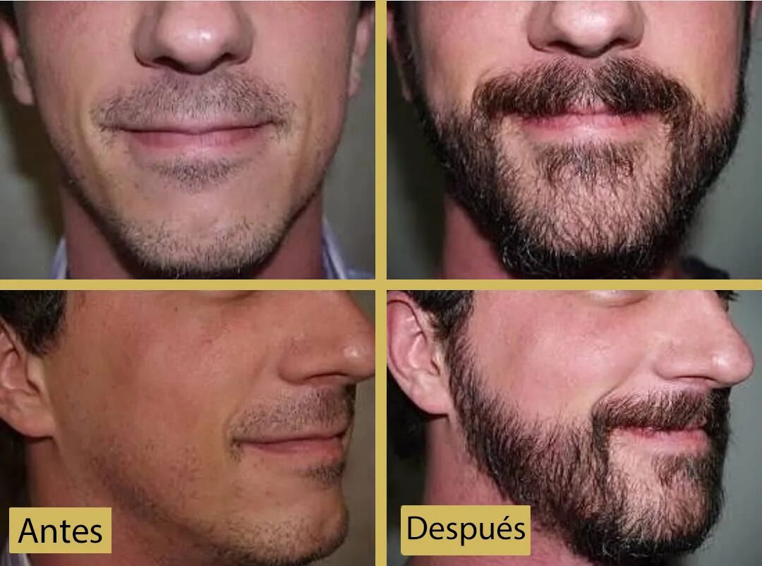 Трансплантация волос на бороду. Борода после пересадки. Трансплантация бороды до после. Наращения бороды. Какие волосы на бороде