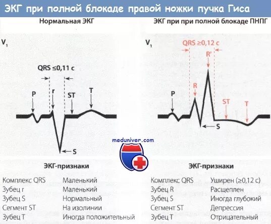 Блокада qrs. ЭКГ: синусовый ритм. Блокада правой ножки пучка Гиса.. ЭКГ признаки блокады левой ножки пучка. ЭКГ признаки блокады ножек пучка Гиса. Блокада правой ножки пучка Гиса на ЭКГ.