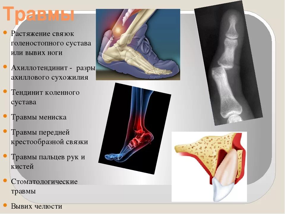 Разрыв связок голеностопного сустава. Растяжение голеностопного сустава. Растяжение связок стопы. Повреждение связок стопы.