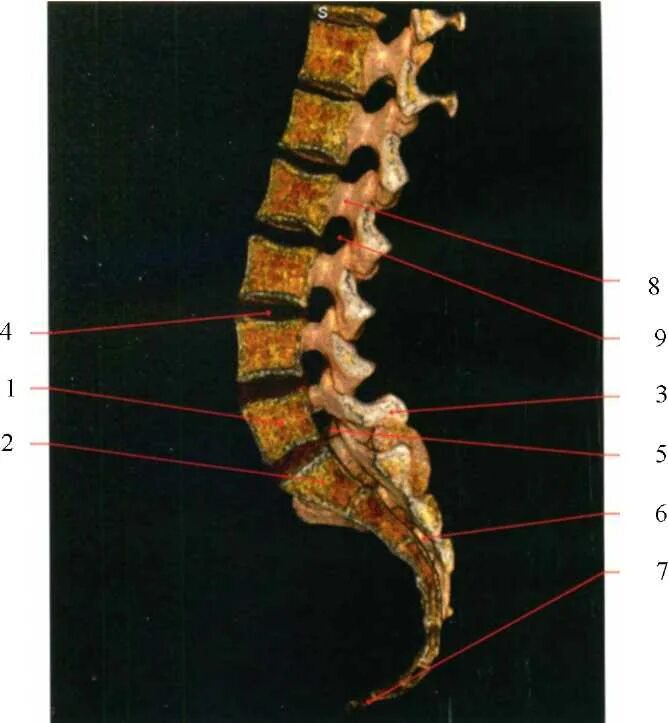 L4 l5 остистый отросток. Мрт пояснично-крестцово-копчикового отдела позвоночника. Позвонки крестца кт. Пояснично-крестцовый отдел и копчиковый отдел позвоночника. Крестовой отдел позвоночника