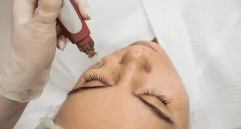 Мезотерапии dermapen