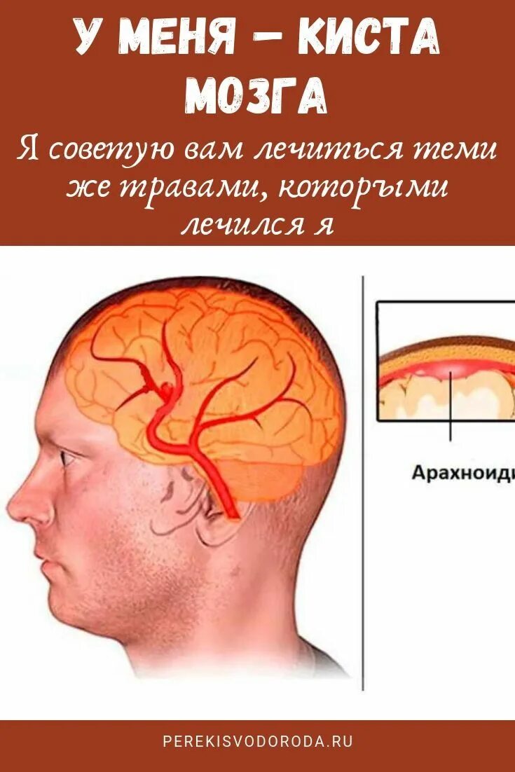 Арахноидальные изменения ликворокистозного характера. Арахноидальные кисты головного мозга классификация. Арахноидит клинические проявления.