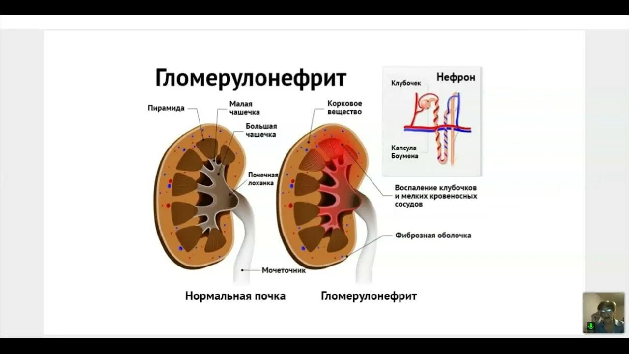 Гломерулонефрит какого типа. Гломерулонефрит почка. гломерулонефрит картинки. острый гломерулонефрит почка.