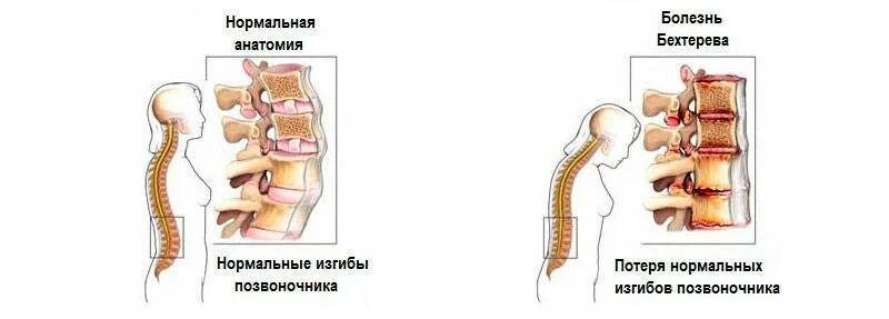Анкилозирующий спондилит болезнь Бехтерева. Болезнь Бехтерева шейного отдела. Болезнь Бехтерева позвоночник кт. Болезнь Бехтерева этиология.