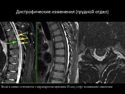 Дегенеративные изменения пояснично крестцового отдела что это