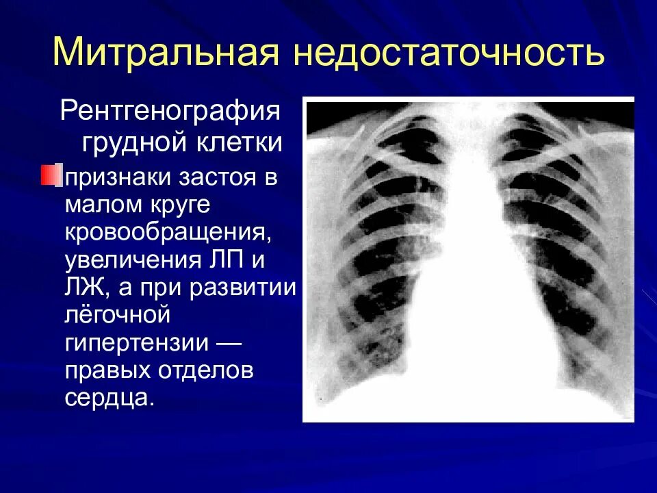 Застой по малому кругу. Митральная недостаточность рентген. Недостаточность митрального клапана рентгенограмма. Недостаточность митрального клапана рентген. Митральная конфигурация сердца рентген.