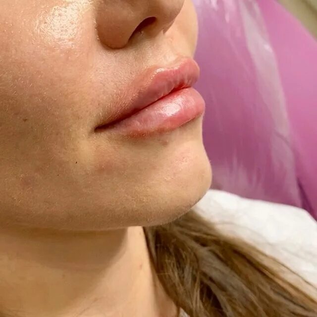 косметолог губы спб. косметолог губы спб. косметолог губы спб. косметолог губы спб. красивая форма увеличенных губ.