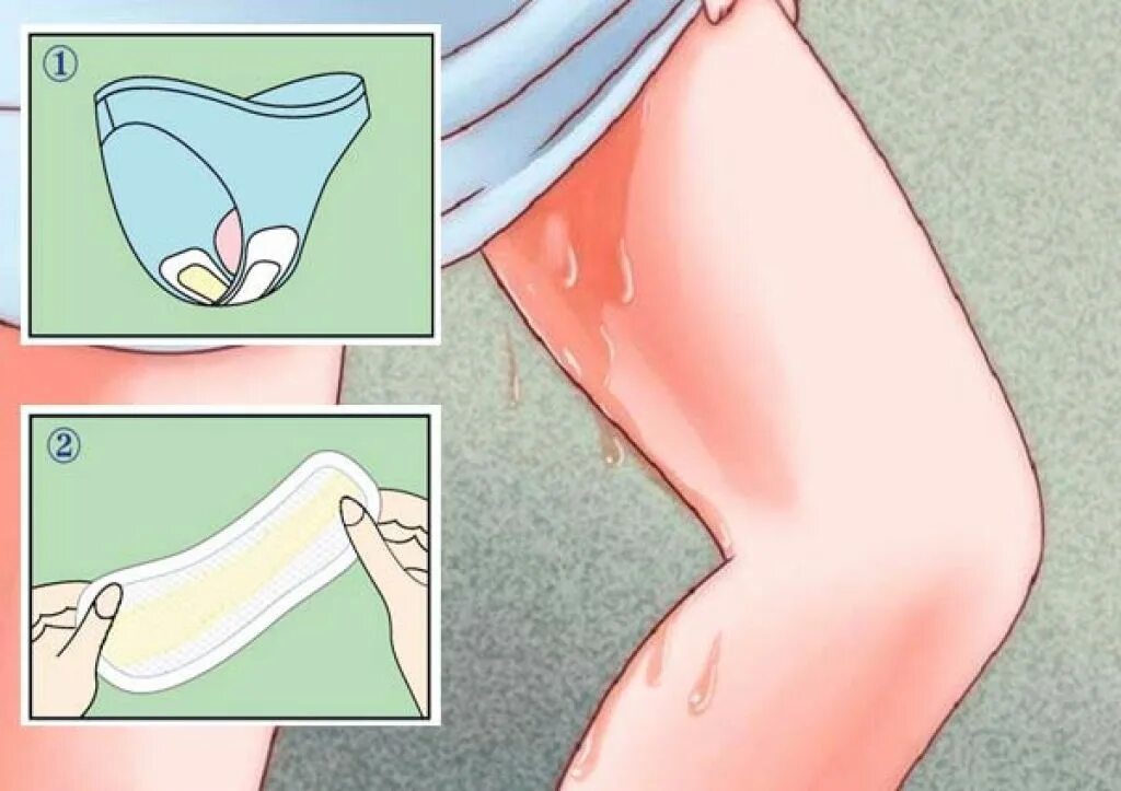 Желто зеленые выделения. Выделения после установки пессария. Желто бежевые выделения. Желтые выделения после кс. Выделения после установки пессария.