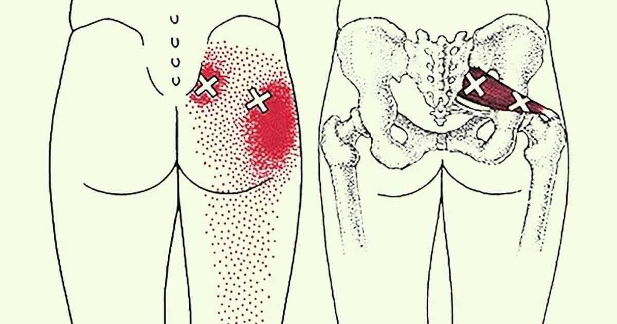 Почему после уколов болит ягодица. Прострел седалищного нерва. Седалищный нерв при уколе в ягодицу. Седалищный нерв левой ягодицы. Опоясывающий герпес седалищного нерва.