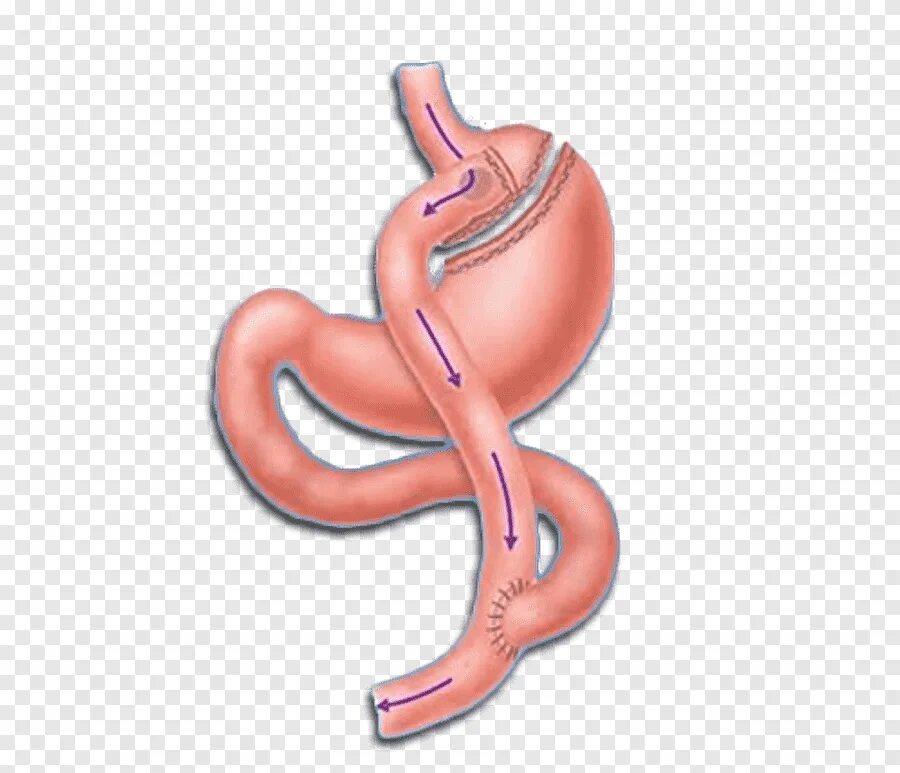 Резекция и шунтирование желудка разница. Желудочное шунтирование (gastric bypass). бариатрическая хирургия bypass. бариатрическая операция шунтирование желудка. желудочное шунтирование, roux-en-y.