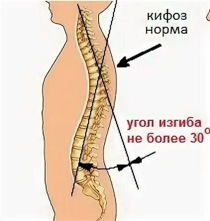 Градусы кифоза