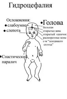 Гидроцефалия без гидроцефалии
