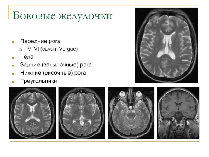 Боковые желудочки анатомия кт. Затылочный Рог бокового желудочка. Треугольник бокового желудочка. Височный Рог бокового желудочка. Расширение боковых рогов