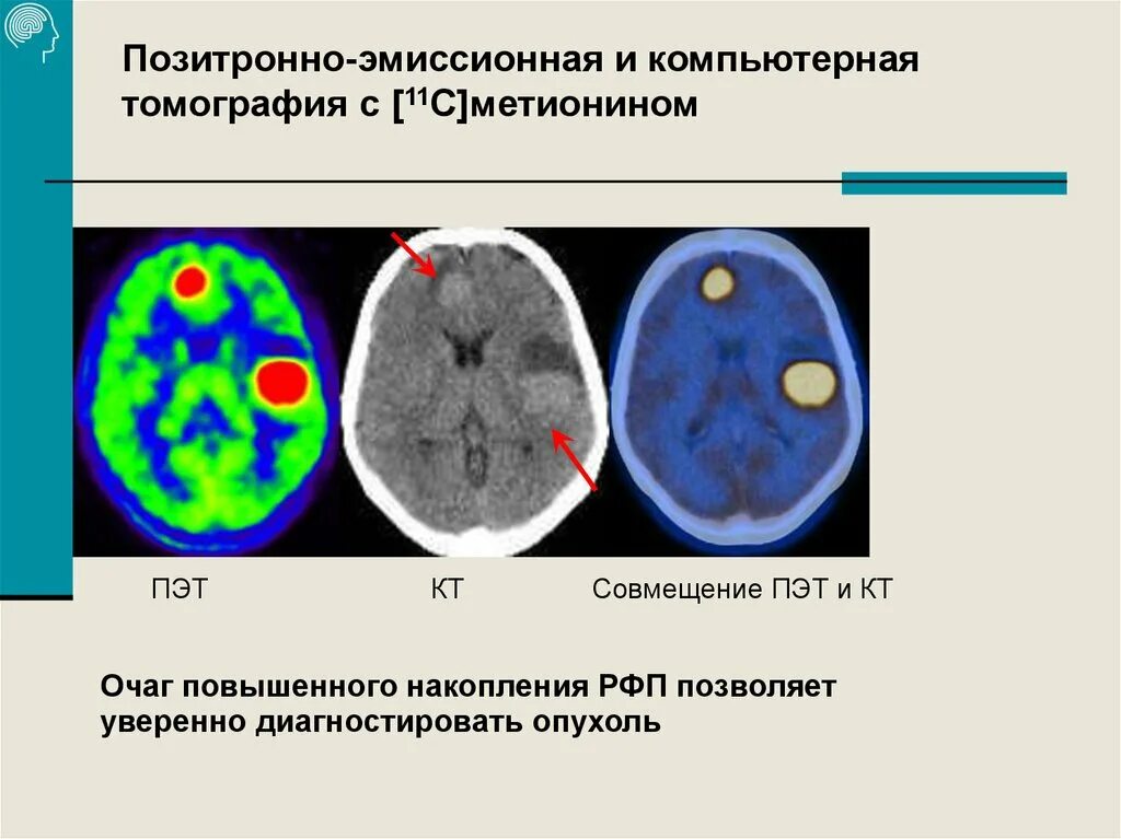 Рфп при пэт кт. ПЭТ кт с 11 с метионином. Позитронно-эмиссионная томография опухоли. Позитрон-эмиссионная  томография: ПЭТ. Позитронно эмиссионная томография Позитрон.