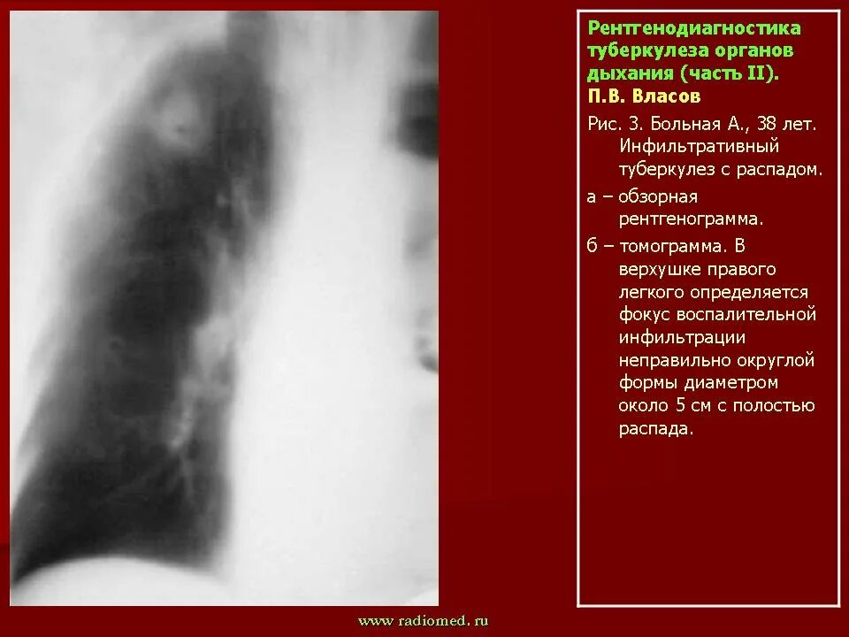 Туберкулез сегодня. Рентгенодиагностика туберкулеза. Лучевая диагностика туберкулеза. Рентгенологическая диагностика туберкулеза. Методы лучевой диагностики туберкулёза органов дыхания.