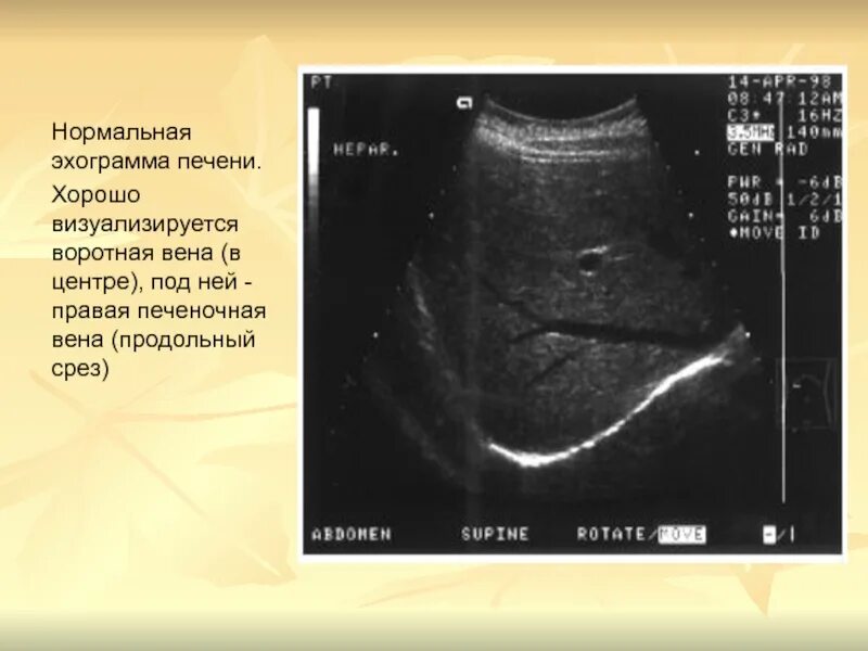 Эхограмма печени продольная. Что значит сосудистый рисунок печени. Сосудистый рисунок печени обеднен. Цирроз печени узи признаки. Кровоснабжение желчного пузыря анатомия.