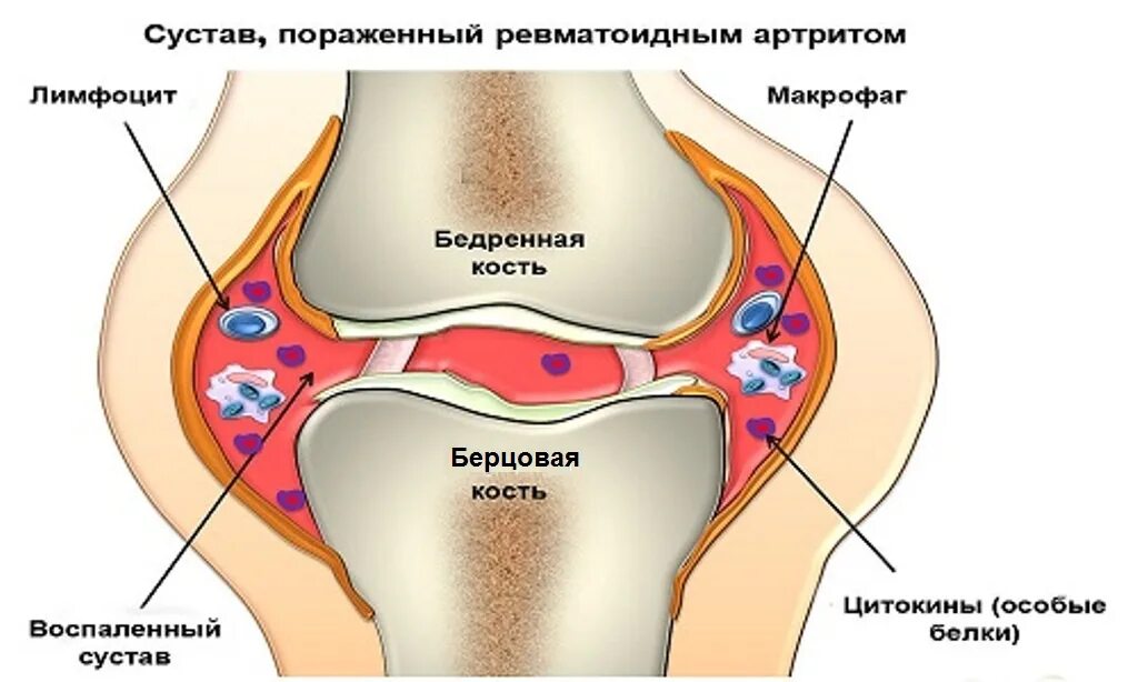 Ревматоидный артрит это. Ревматоидный артрит поражение суставов. Ревматоидный артрит суставные проявления.