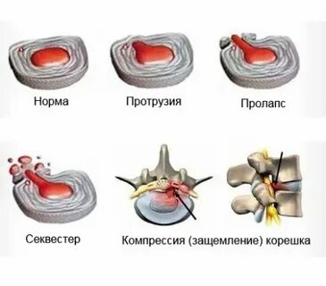 Перед грыжей