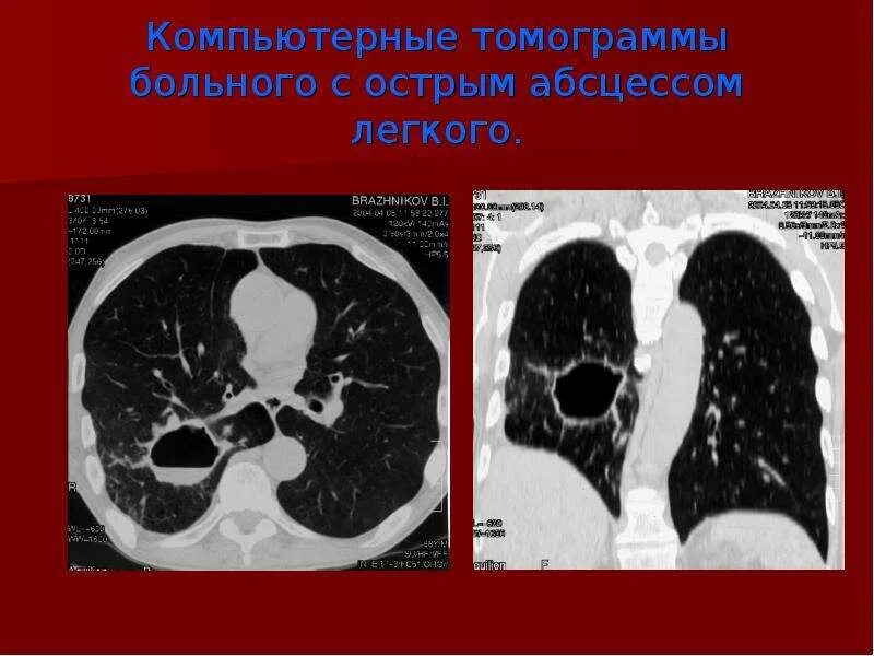 Острый абсцесс легкого кт. Кт снимки легких абсцесс. Острое поражение легких