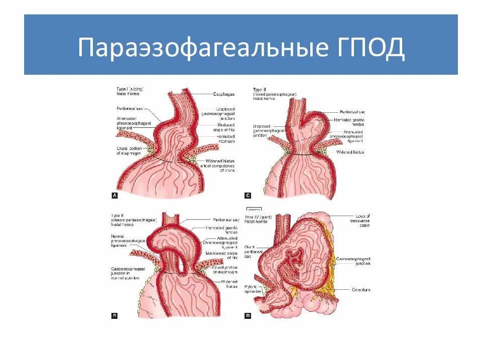 Диафрагмальный пищевода