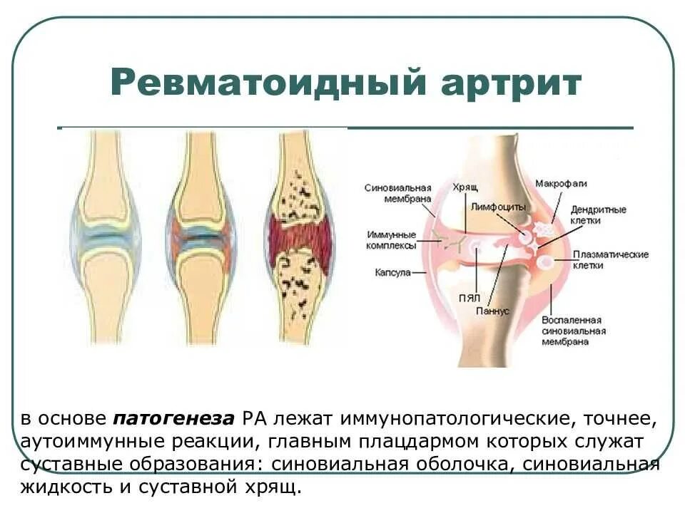 Суставные поражения при ревматоидном артрите. Ревматоидный артрит синовиальная жидкость. Ревматоидный артрит аутоиммунное заболевание патогенез. Ревматоидный артрит коленного сустава клиника. Артроз коленного сустава название