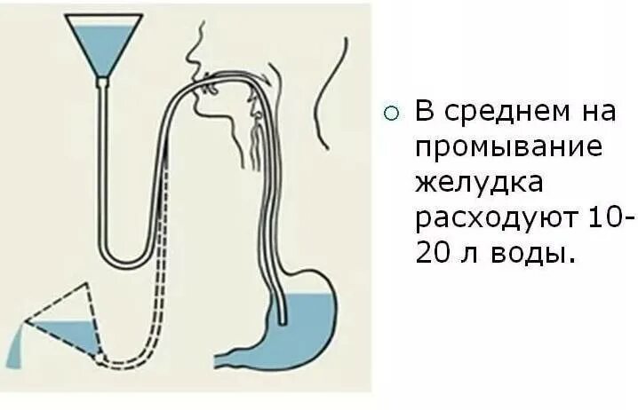 Прочистить желудок в домашних. Промывание желудка. Зонд для промывания желудка. Промывание желудка схема. Промывание желудка алгоритм.