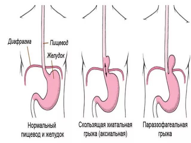 Диафрагмальный пищевода