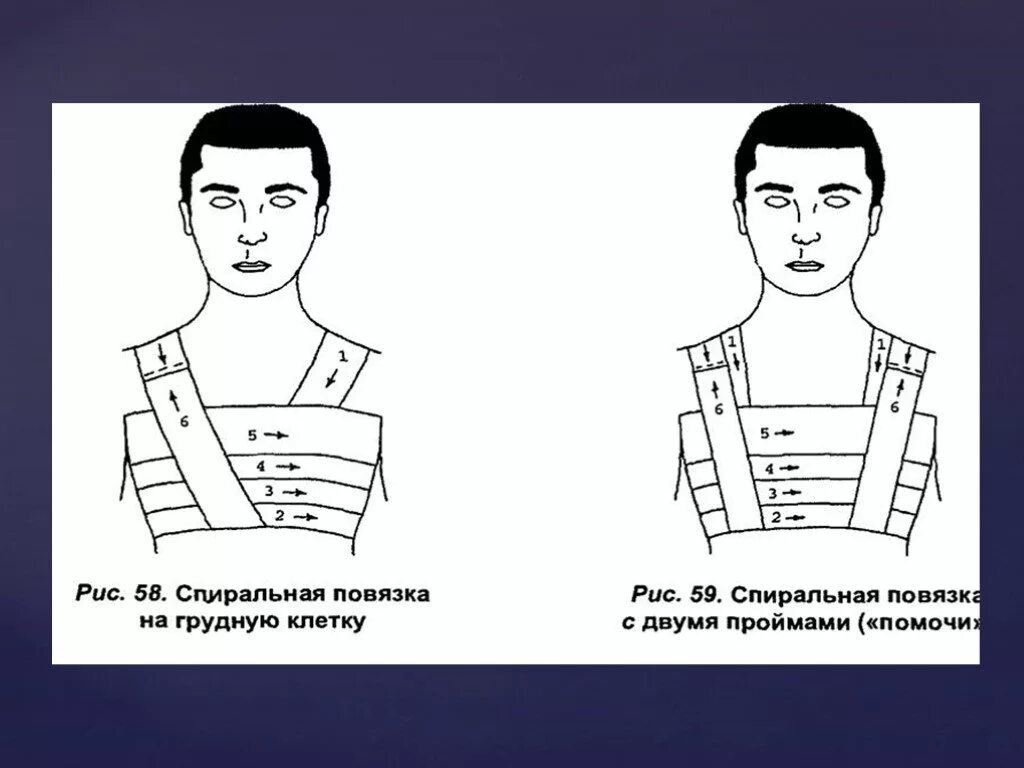 Техника наложения повязок на грудную клетку. Наложение окклюзионной (герметизирующей) повязки. Наложение спиральной повязки на грудную клетку. Повязка спиралевидная на грудную клетку при. Десмургия спиральная повязка на грудную клетку.