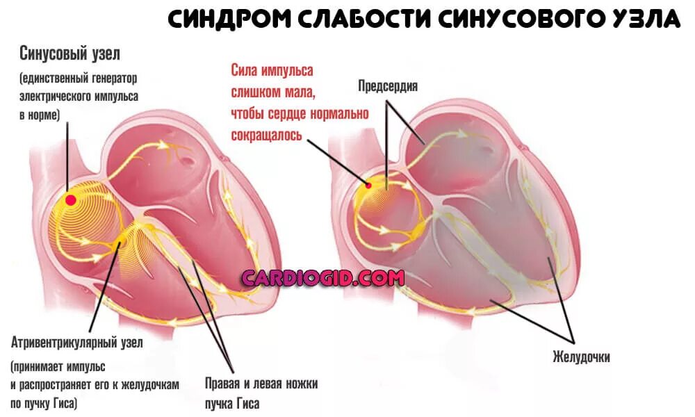 Дисфункция синусового узла что это. Слабый синусовый узел сердца. Слабый синусовый синдром. Синдром слабости синусового узла. Признаки синдрома слабости синусового узла.