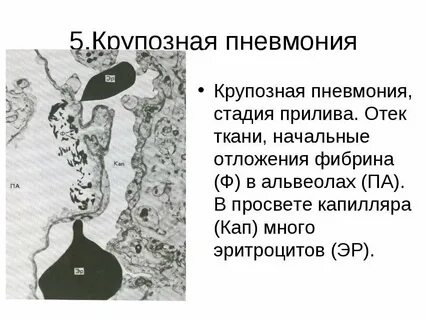 Крупозная пневмония стадии