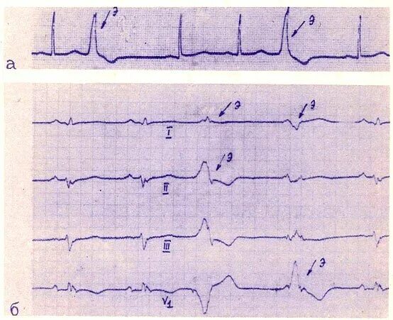 Политопная полиморфная желудочковая экстрасистолия. Экг монотопные желудочковые экстрасистолы. Политопная желудочковая экстрасистолия на экг. Политопные желудочковые экстрасистолы на экг. Экг монотопные желудочковые экстрасистолы.