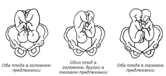 Положение плода в животе. Предлежание плодов при многоплодной беременности. Положение плодов при многоплодной беременности. Продольное тазовое предлежание 1 позиция. Тазовое предлежание плода двойня.